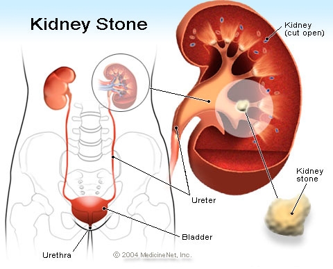 IMAGE-3-SYMPTOMS-OF-PARATHYROID-CANCER