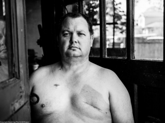 At age 43, William Becker discovered that he had Stage 3 breast cancer. Two years later, he found out that it had progressed to Stage 4 metastatic cancer. Photo: David Jay