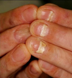 Half and Half nails Lee et al, Annals of Dermatology