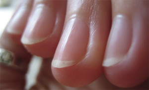 vertical-ridges-fingernails