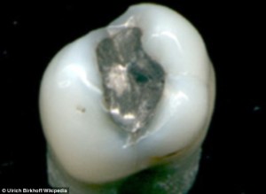 Mercury constitutes 50 per cent of silver fillings and can degrade and cause heavy metal poisoning over time - though they are still considered save by the American Dental Association