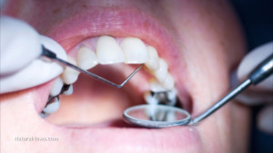 Mercury-Cavities-Dentist-Teeth