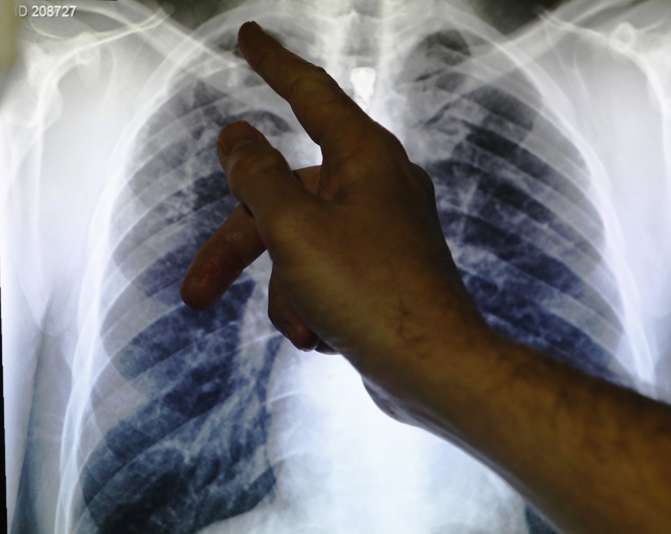 An X-ray showing a pair of lungs infected with tuberculosis. Luke MacGregor / Reuters
