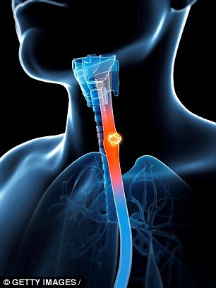 Oesophageal cancer is the eighth most common cancer in the world