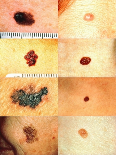 melanoma-normal-mole