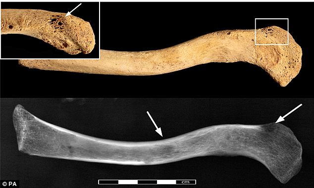 The researchers could only speculate on the cause of the cancer, also found in the left clavicle, pictured, with theories being carcinogens such as smoke from wood fires, genetic factors or from an infectious disease caused by parasites