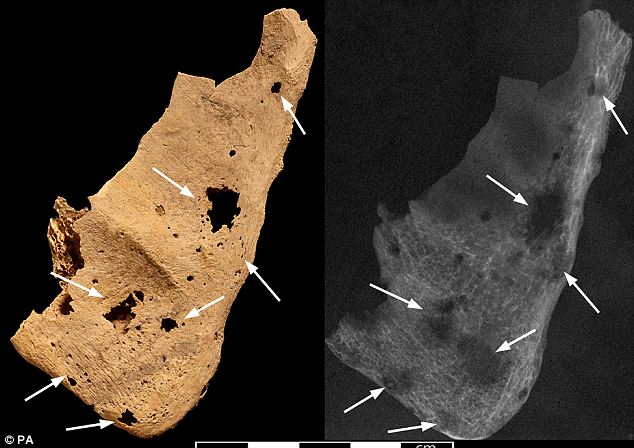 Signs of the metastatic cancer, shown via pathalogical lesions, were also found in the right scapula, pictured left. Tests using radiography and a scanning electron microscope provided clear imaging of these lesions, pictured right