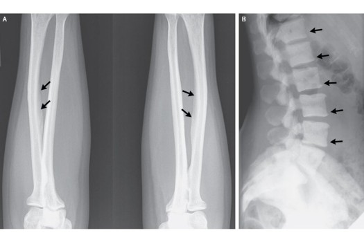skeletal-fluorosis-130320